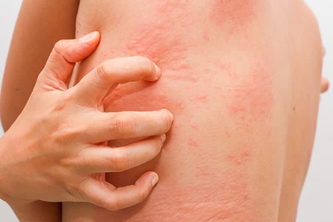 Skin Irritation