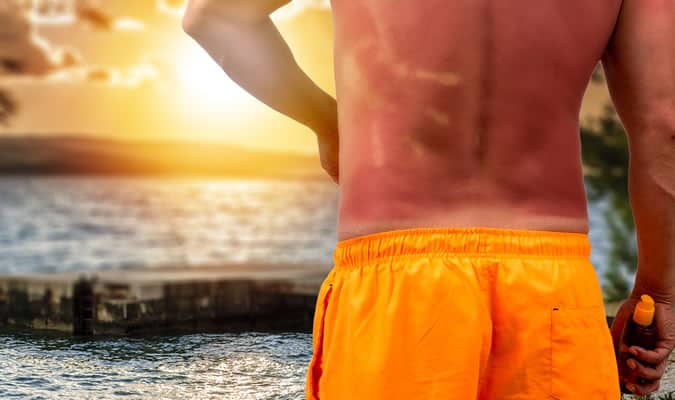 Common Spring/Summer Men's Fashion Mistakes - Burn skin