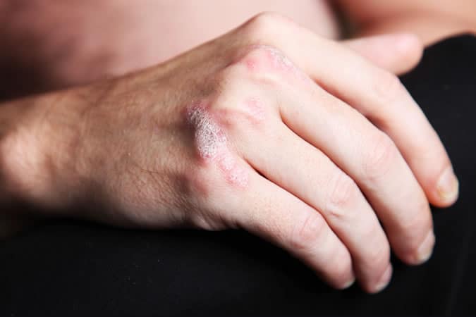 Psoriasis is often worse in winter - so avoid stress triggers