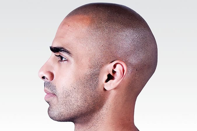 His Hair Clinic Micro Scalp Pigmentation