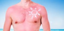 How To Deal With Sunburn