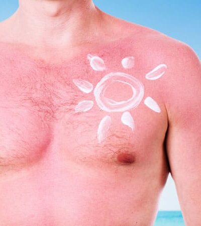 How To Deal With Sunburn