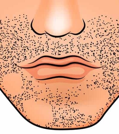 Why Am I Losing My Beard Hair?