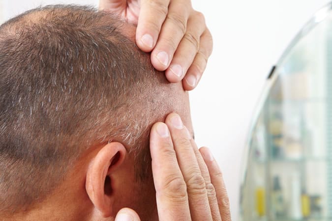 Hair loss