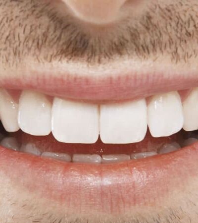 The Best Teeth Whitening Products You Can Buy In 2026