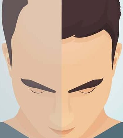 Hair Transplants: Everything You Need To Know