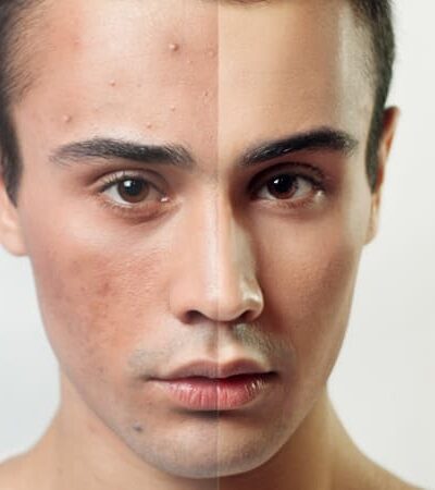 Acne: What It Is And How To Get Rid Of it